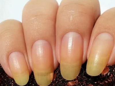 Почему желтые ногти на руках причины что делать лечение